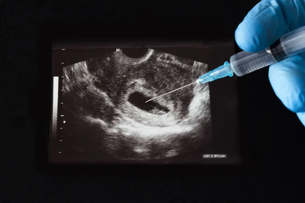 O médico injeta um tiro na gravidez uzi, um aborto, uma seringa, uma luva, um fundo preto — Fotografia de Stock