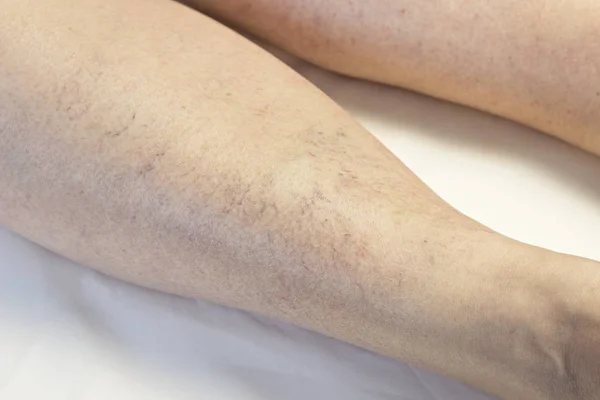 Varicose veins on the leg, close-up, white background — Stock Photo, Image