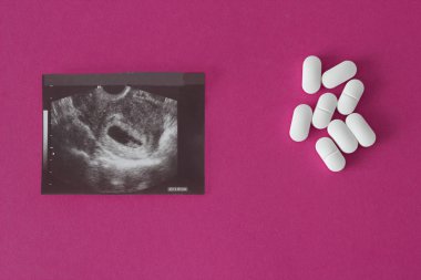 Uzi of pregnancy on a pink background and pills, abortion. clipart