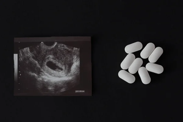 Ciąży, strzał uzi i pigułki na czarnym tle. Aborcja, zbliżenie — Zdjęcie stockowe
