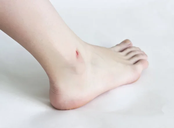 Женская нога на белом фоне, порез после бритья ног — стоковое фото