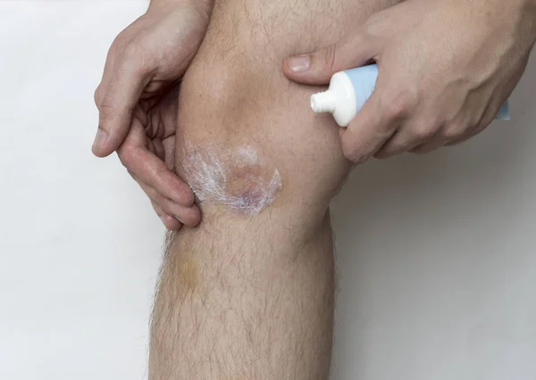 Um homem mancha um hematoma em sua perna com pomada — Fotografia de Stock