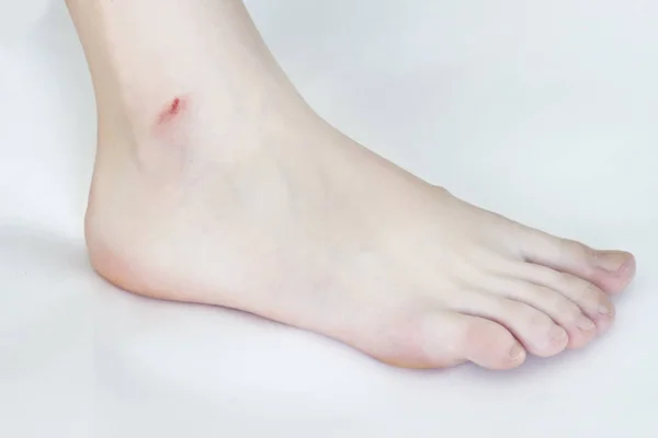 Nogi kobiece kobieta na białym tle nacięcie po golenia nóg — Zdjęcie stockowe