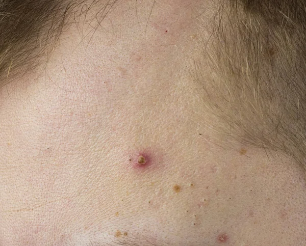 Grande espinha vermelha na testa do homem, close-up, pele problema, cabeça branca — Fotografia de Stock