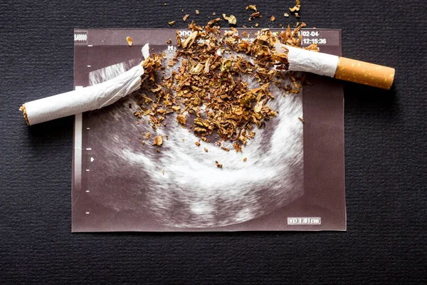 Broken cigarette on a picture of pregnancy uzi, smoking and pregnancy, gestation and cigarette