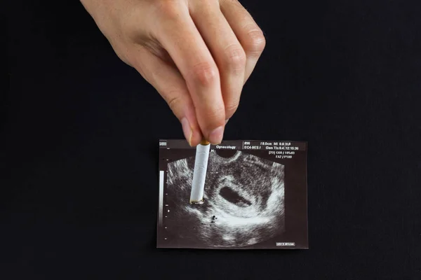 A woman\'s hand, a future mother extinguishes a cigarette on a picture of a pregnancy uzi, pregnancy and smoking, cigarette and pregnancy