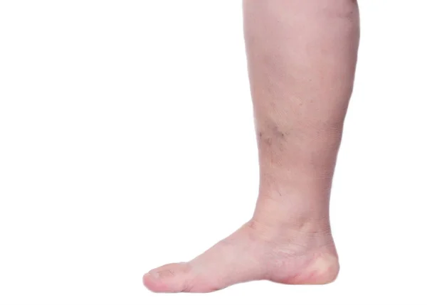 Нога пожилой женщины на белом фоне с варикозным расширением вен, крупным планом, изоляцией, флеборизмом и тромбозом — стоковое фото