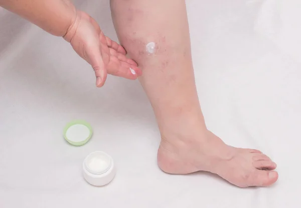 Uma mulher idosa aplica pomada de cura em sua perna em varizes, pernas flebeurísticas, varizes, fundo branco — Fotografia de Stock