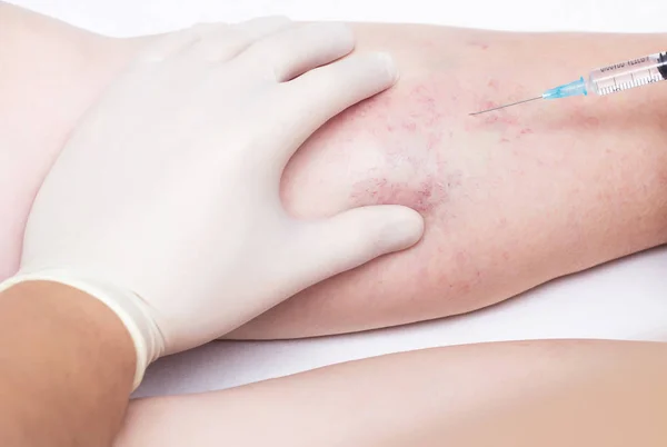 Bir doktor bir enjeksiyon varis bir kadın s bacak, yakın çekim, skleroterapi, sıyırma, phlebeurysm, tıbbi yapıyor