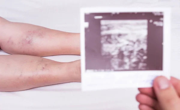 Doctor holds in his hand the result of ultrasound of the veins of the lower extremities for the presence of thrombosis, close-up, female legs, white background, varicose veins — Stock Photo, Image