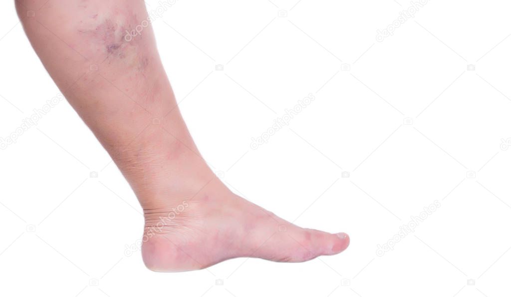 Leg of an elderly woman on a white background with varicose veins, close-up, isolate, phlebeurysm and thrombophlebitis, problem