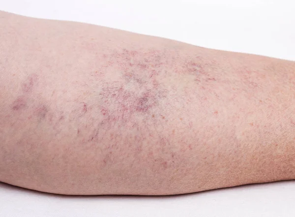 Vascular marks on the skin from varicose veins, vascular pattern on the skin, close-up, phlebeurysm, problem, white background — Stock Photo, Image