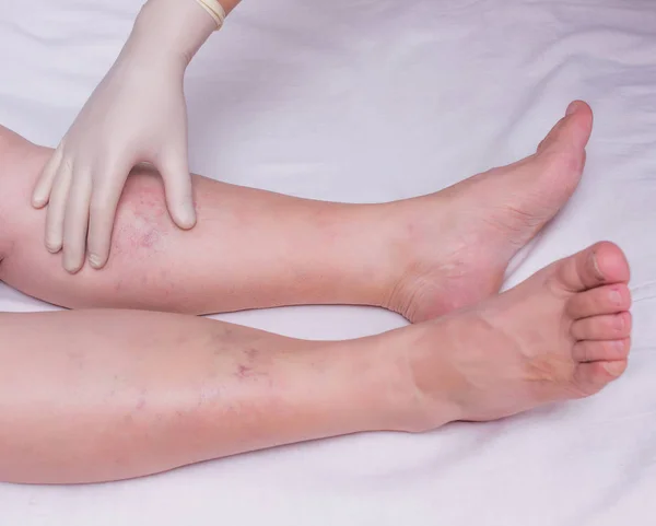 Ο γιατρός εξετάζει τα πόδια του ασθενούς για την παρουσία και το βαθμό των κιρσών στα πόδια, γκρο πλαν, άσπρο φόντο, γυναίκα phlebeurysm, χέρι — Φωτογραφία Αρχείου