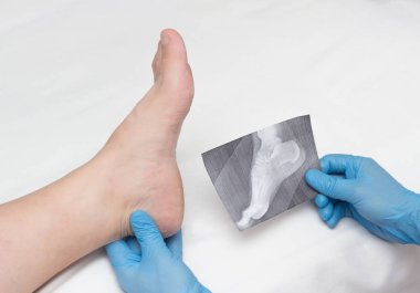 Medikal Ürünler bir doktor röntgen ayak tutar ve topuk çıkıntısı bir kadın, yakın çekim, osteophytes ve topuk, fasya ile ağrıyan bacak inceliyor