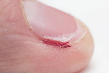Çivi yırtık burr ve kan, manikür, makro, beyaz arka plan, tıbbi, barb ile kapalı yırtık