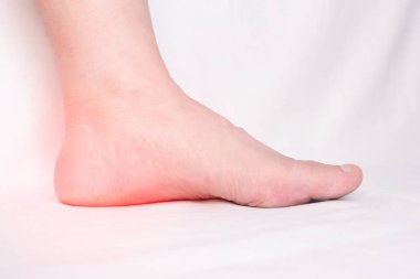 Female leg with a sore heel with a heel spur, spike and osteoite in the heel, pain, close-up, white background, copy space clipart