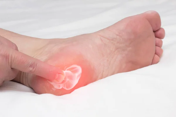 A woman rubs a healing balm cream for the treatment of thorns and osteophytes, a spot spur in the heel, removal of inflammation, close-up, medical — Stock Photo, Image