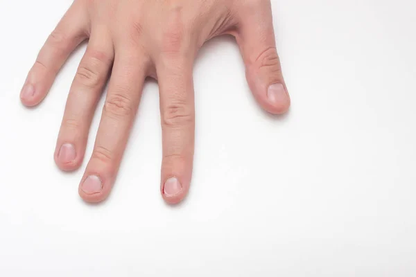 Uma mão sobre um fundo branco cujas unhas são mordidas e rasgadas, um mau hábito, close-up, espaço de cópia, manicure — Fotografia de Stock