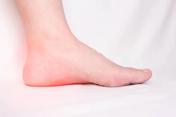 Female leg with a sore heel with a heel spur, spike and osteoite in the heel, pain, close-up, white background, copy space — Stock Photo, Image