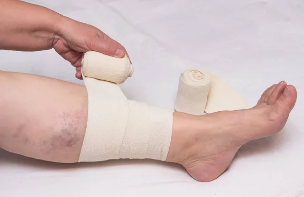 Γυναίκα Επίδεσμοι πόδι με ελαστικό επίδεσμο κατά των κιρσών σε πόδια και θρόμβωση, γκρο πλαν, άσπρο φόντο, phlebeurysm, ιατρική, τραύμα — Φωτογραφία Αρχείου