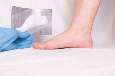 Doktor röntgen elinde tutuyor ve hastanın ayak topuk çıkıntısı, yakın çekim, plantar fasiit inceliyor