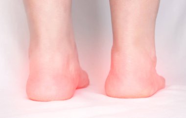 Beyaz bir arka planda topuk spurs, yakın çekim, plantar fasiit, Ortopedi uzmanı ile yetişkin bir kadının bacakları