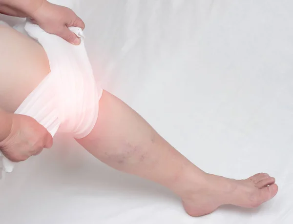 Behandeling van artrose van de knie en de ontsteking met een medische comprimeren, strakke bandage, close-up, kopie ruimte, synovitis — Stockfoto