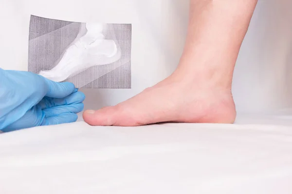 Ο γιατρός κατέχει ακτινογραφία στο χέρι του και εξετάζει το πόδι ασθενούς με γκρο πλαν, άκανθα πτέρνας, πελματιαία απονευρωσίτιδα — Φωτογραφία Αρχείου
