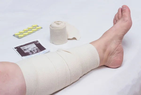 Компрессионная терапия варикозного расширения вен в ногах женщины, лечение варикозного расширения вен с помощью эластичного бинта, сосудистой системы — стоковое фото