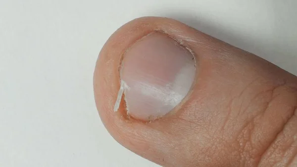 Instalacji nienadzorowanej i złamane paznokci, pęknięty, pielęgnacji skóry, złe paznokci — Zdjęcie stockowe