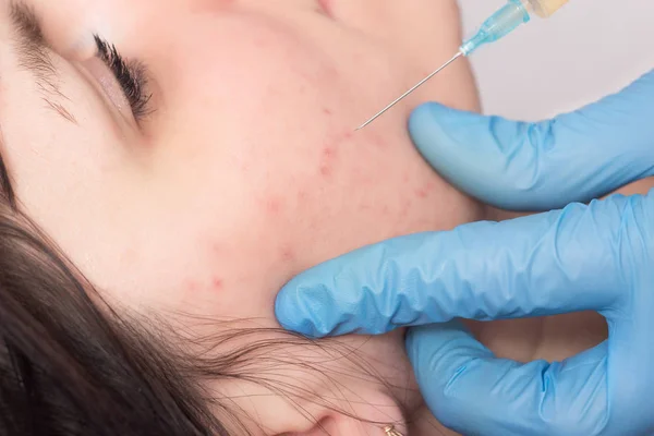 Acne treatment on the face, plasma-lifting, plasma therapy, the doctor makes the injection of blood plasma to the patient, close-up