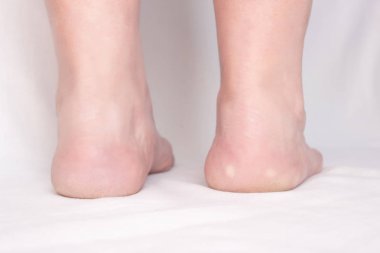 Kadın ayak topuk ile beyaz bir arka plan üzerinde lekeler ile teşvik hastalığı, yakın çekim, plantar fasiit