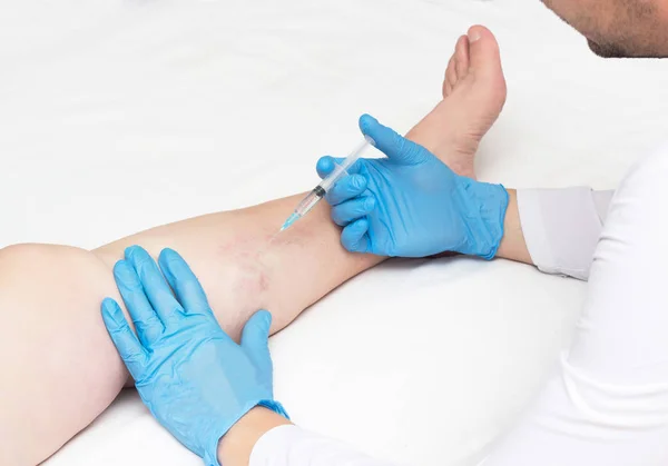 Γιατρός εκτελεί σκληροθεραπείας για κιρσούς στα πόδια, κιρσοί θεραπεία φλέβα, διάστημα αντίγραφο, ένεση — Φωτογραφία Αρχείου