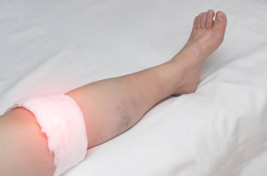 Tıbbi basmak ortak bir kadın diz ile geleneksel tıp, yakın çekim, inflamasyon tedavisinde diz üstünde