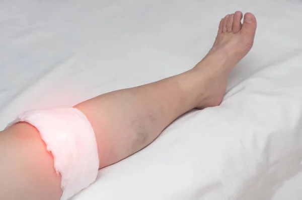 Medische kompres op het kniegewricht bij een vrouw, de behandeling van de knie met traditionele geneeskunde, close-up, ontsteking — Stockfoto
