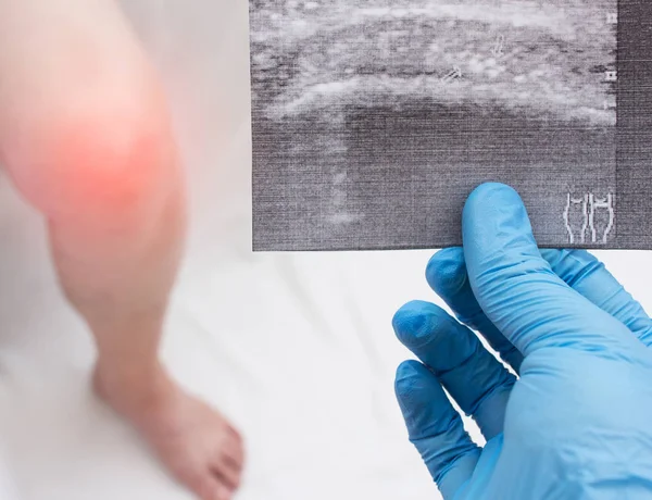 Arzt im medizinischen Handschuh hält Ultraschall des Knies der Frau, Knieschmerzen, Entzündungen, Nahaufnahme, Patientin — Stockfoto