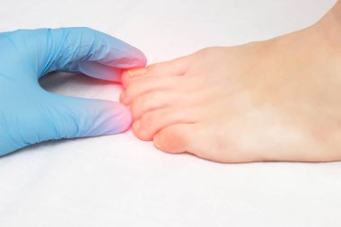 Doktor kadın bacak ve mantar hastalıkları, mantar, yakın çekim, beyaz arka plan, ağrı batık tırnak inceliyor