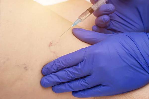 Doktor bir enjeksiyon skleroterapi varis, phlebology, yakın çekim, profesyonel yapar