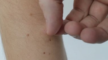 Bir kabuk deri yara, tıbbi, ağrı, genç bir adam gözyaşları