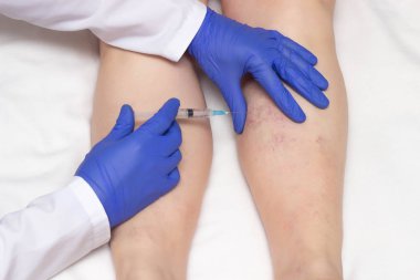 Doctor in medical gloves injects sclerotherapy procedure on the legs of a woman against varicose veins, close-up, ozone therapy, medical clipart