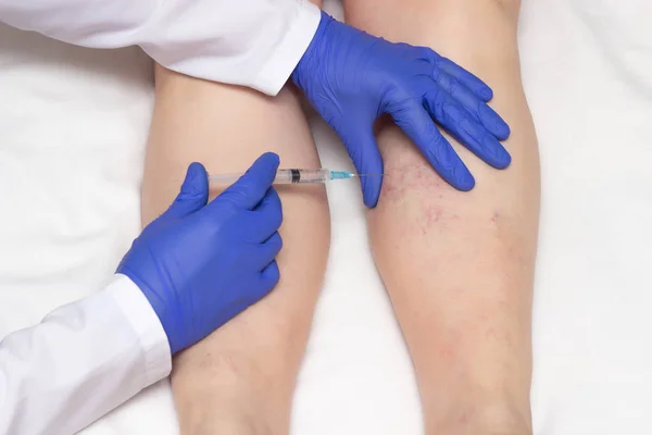 Médecin en gants médicaux injecte une procédure de sclérothérapie sur les jambes d'une femme contre les varices, gros plan, thérapie à l'ozone, médical — Photo