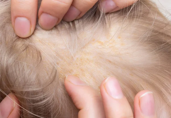 Erupção cutânea seborreica na cabeça da criança, dermatite seborreica, close-up, cuidados de saúde, medicamento — Fotografia de Stock