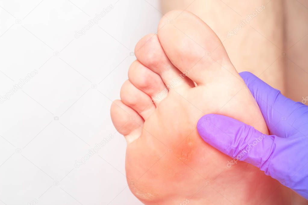 Doctor dermatologist examines the sore foot of a patient whose coarse and dry skin and natoptysh on the sole, close-up, copy space, natoptysh
