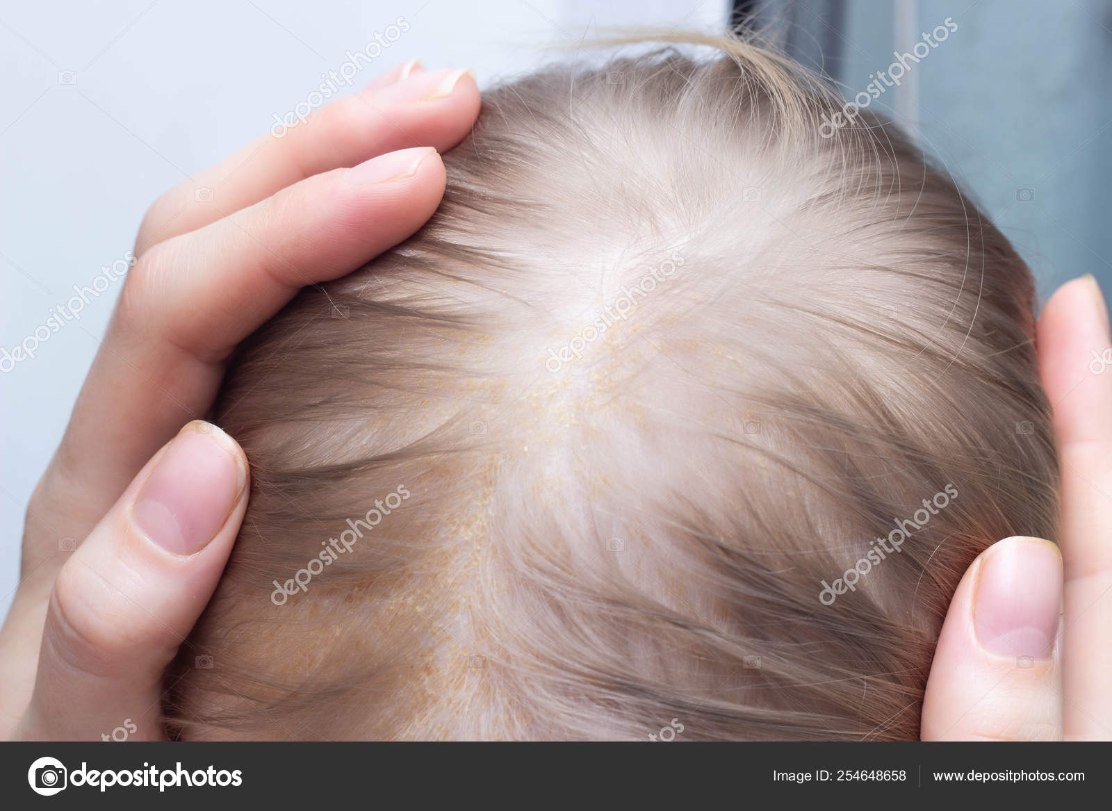 Como tratar hongos en la piel de un nino