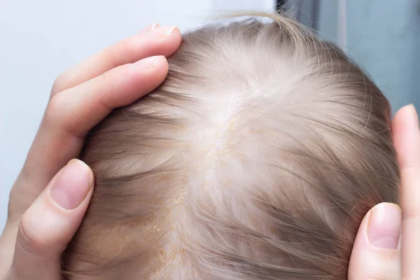Dermatitis seborreica por dermatitis fúngica en la cabeza de un niño, primer plano, corteza seborreica, dermatología — Foto de Stock