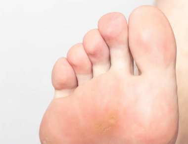 Kuru mazol ve natoptysh ile bir iç çekirdek sole ve bacak bir kişi, yakın çekim, Dermatoloji, kusur, sorun