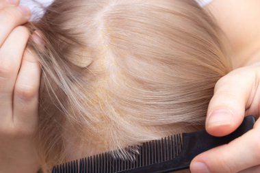 Anne bebek s kafa, yakın çekim, Seborrhoeic Dermatit, inflamatuar Seboreik kabuk penye