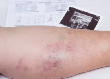 Varis ile yaşlı bir kadının bacak, yakın çekim, ultrason muayene belgeleri, flebeurysm, tromboz