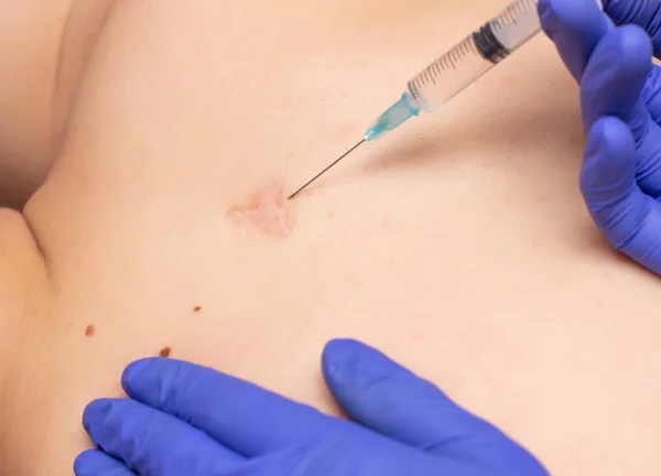 Врач-косметолог вводит мезотерапию и подает с озонотерапией в шрам на спине человека для рассасывания шрама, крупным планом — стоковое фото