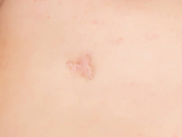 Large scar and scar on the patient's skin after removing an inflamed pimple, close-up, professional — Stock Photo, Image